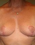 after breast reduction