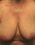 before breast reduction
