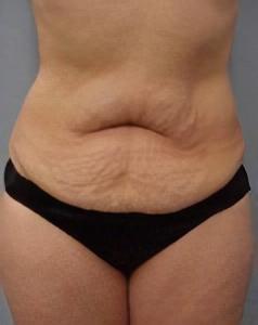 before tummy tuck