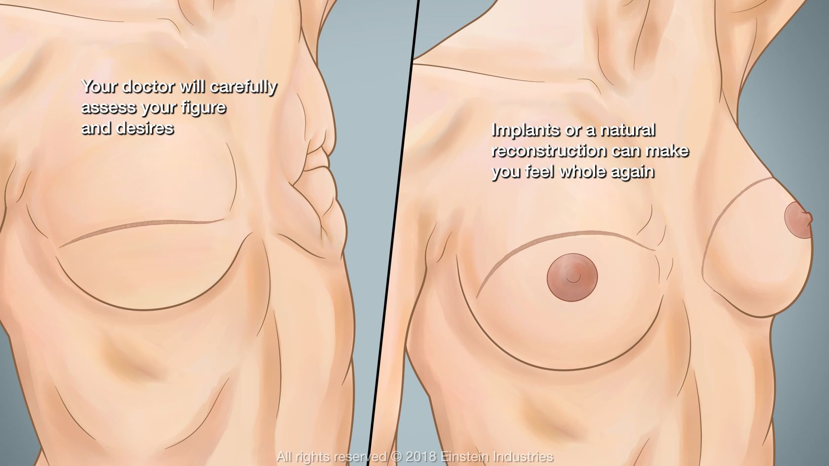 Breast reconstruction illustration