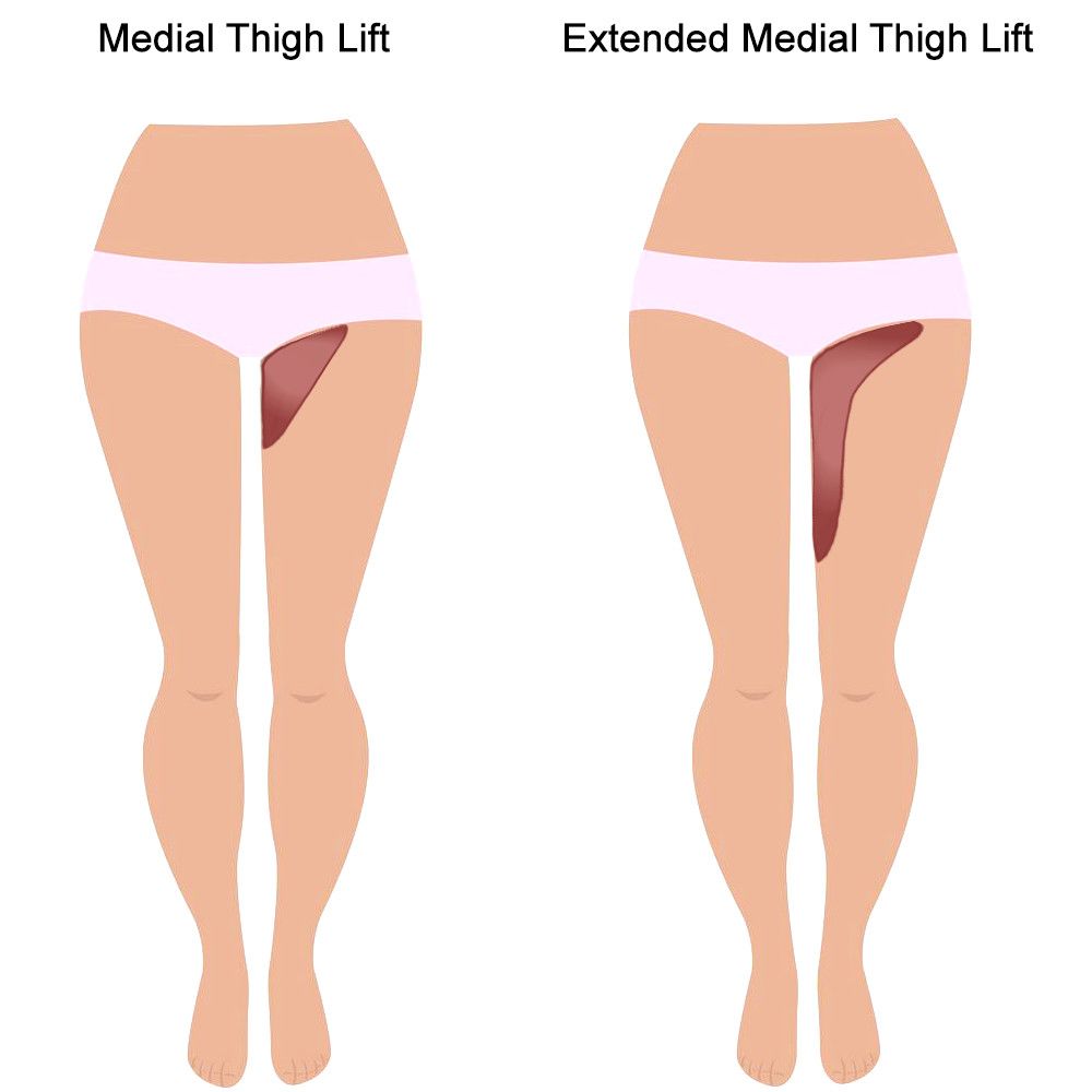 Illustration of a medial thigh lift and extended medial thigh lift.